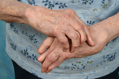 Arthritis