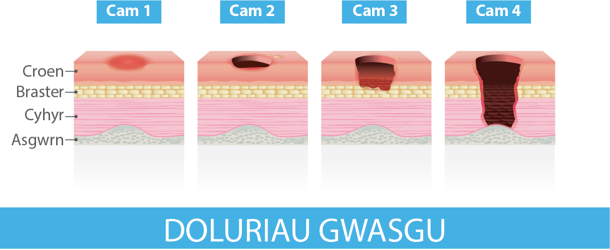 Camau doluriau gwasgu