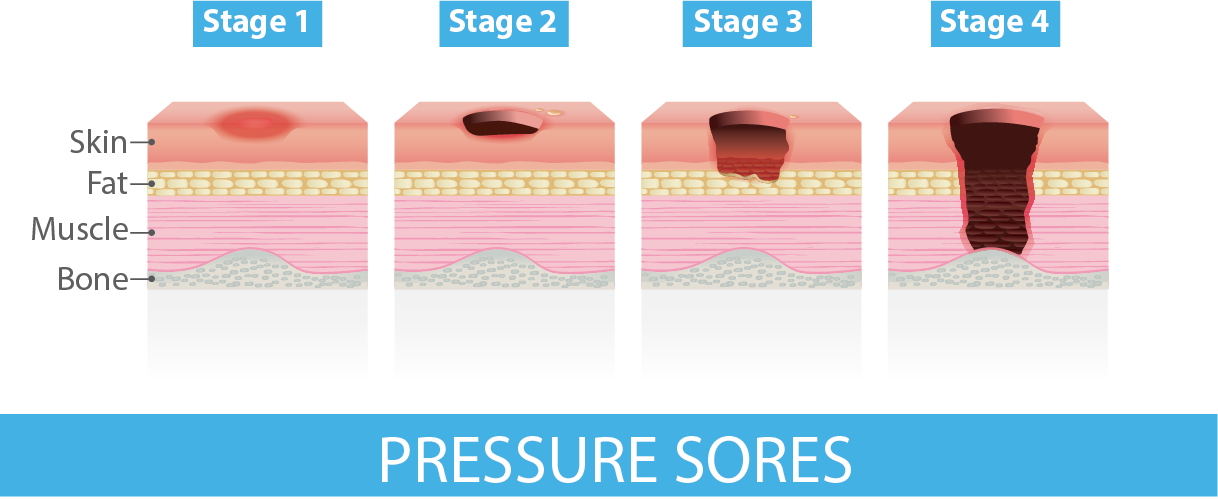 Pressure sores stages