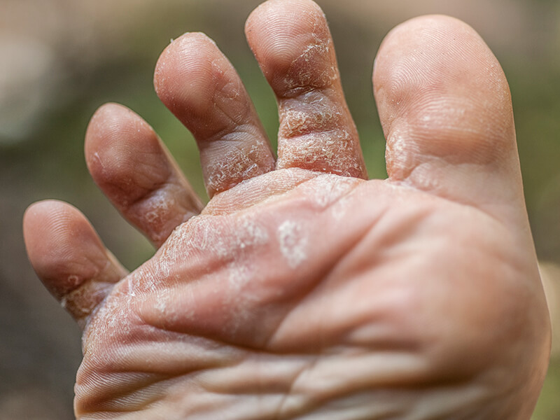 Athletes foot