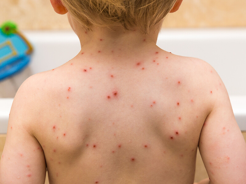 Chickenpox
