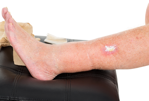 Infected leg wound