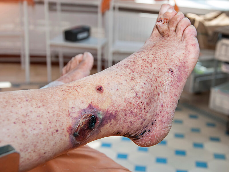 Meningitis (bacterial)