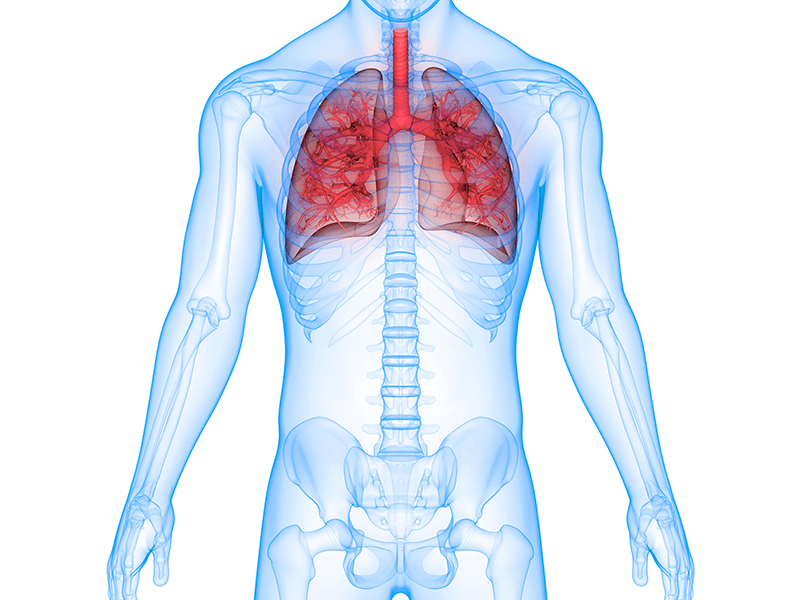Pneumonia