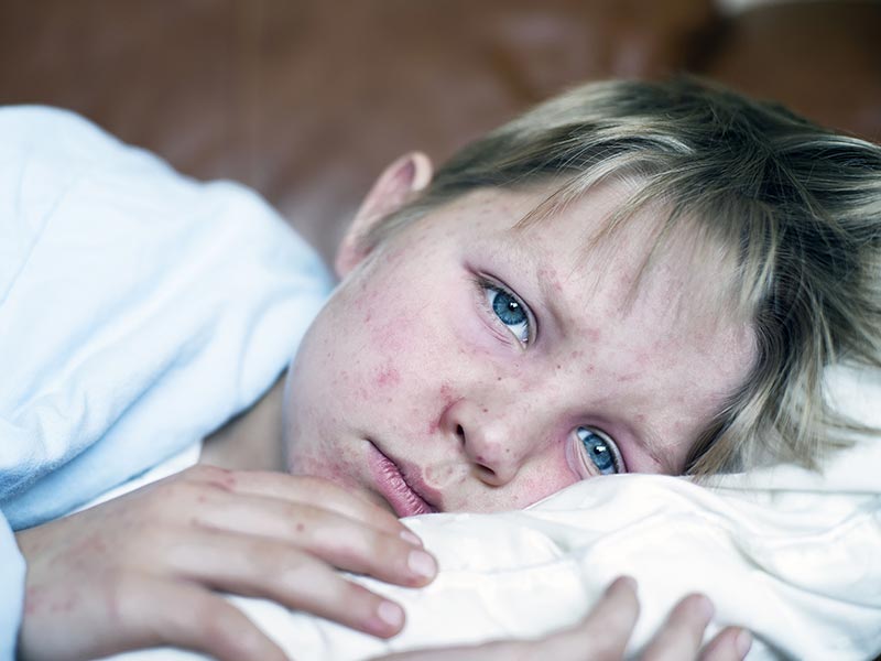 a child in bed with measles