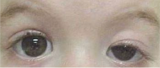 Ptosis left eye