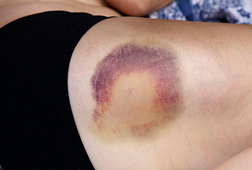 Bruise